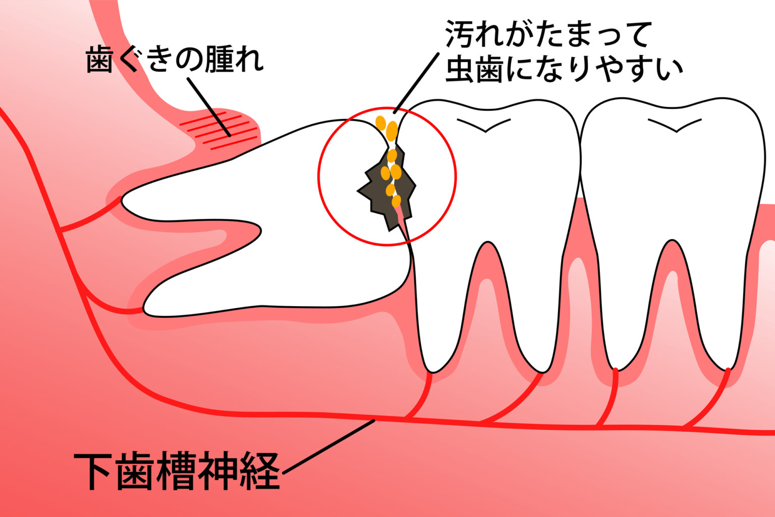小岩（東京都江戸川区）の歯医者、笠原デンタルオフィスの親知らずの抜歯